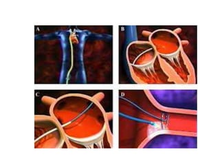 Arrythmia . Anu k George