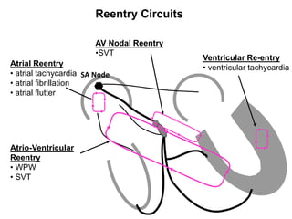 Atrial Reentry
• atrial tachycardia
• atrial fibrillation
• atrial flutter
Atrio-Ventricular
Reentry
• WPW
• SVT
Ventricular Re-entry
• ventricular tachycardia
AV Nodal Reentry
•SVT
Reentry Circuits
SA Node
 