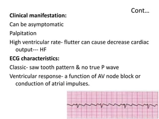 Cont…
Clinical manifestation:
Can be asymptomatic
Palpitation
High ventricular rate- flutter can cause decrease cardiac
output--- HF
ECG characteristics:
Classic- saw tooth pattern & no true P wave
Ventricular response- a function of AV node block or
conduction of atrial impulses.
 