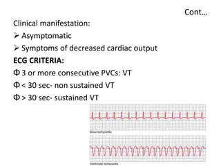 Cont…
Clinical manifestation:
 Asymptomatic
 Symptoms of decreased cardiac output
ECG CRITERIA:
Φ 3 or more consecutive PVCs: VT
Φ < 30 sec- non sustained VT
Φ > 30 sec- sustained VT
 