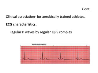 Cont…
Clinical association- for aerobically trained athletes.
ECG characteristics:
Regular P waves by regular QRS complex
 