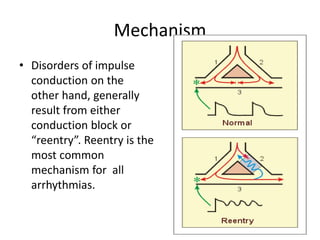 Mechanism
• Disorders of impulse
conduction on the
other hand, generally
result from either
conduction block or
“reentry”. Reentry is the
most common
mechanism for all
arrhythmias.
 