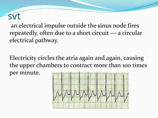 svt
an electrical impulse outside the sinus node fires
repeatedly, often due to a short circuit — a circular
electrical pathway.
Electricity circles the atria again and again, causing
the upper chambers to contract more than 100 times
per minute.
 