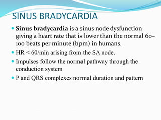 SINUS BRADYCARDIA
 Sinus bradycardia is a sinus node dysfunction
giving a heart rate that is lower than the normal 60–
100 beats per minute (bpm) in humans.
 HR < 60/min arising from the SA node.
 Impulses follow the normal pathway through the
conduction system
 P and QRS complexes normal duration and pattern
 