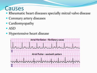 Causes
 Rheumatic heart diseases specially mitral valve disease
 Coronary artery diseases
 Cardiomyopathy
 ASD
 Hypertensive heart disease
 