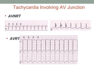 Arrythmias in ICCU | PPT