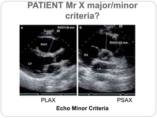 PATIENT Mr X major/minor
criteria?
PLAX PSAX
Echo Minor Criteria
 