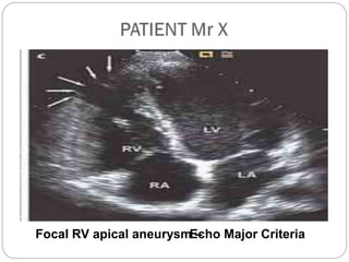 Focal RV apical aneurysm –Echo Major Criteria
 