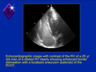 Echocardiographic image with contrast of the RV of a 25 yr
old man of a dilated RV clearly showing enhanced border
delineation with a localized aneurysm (asterisk) of the
RVOT.
 
