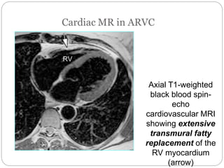 Axial T1-weighted
black blood spin-
echo
cardiovascular MRI
showing extensive
transmural fatty
replacement of the
RV myocardium
(arrow)
 