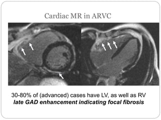 30-80% of (advanced) cases have LV, as well as RV
late GAD enhancement indicating focal fibrosis
 