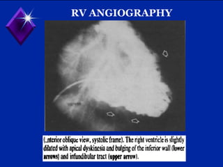 RV ANGIOGRAPHY
 