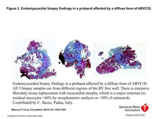Figure 2. Endomyocardial biopsy findings in a proband affected by a diffuse form of ARVC/D.
Marcus F I et al. Circulation 2010;121:1533-1541
Copyright © American Heart Association
Endomyocardial biopsy findings in a proband affected by a diffuse form of ARVC/D.
All 3 biopsy samples are from different regions of the RV free wall. There is extensive
fibrofatty tissue replacement with myocardial atrophy, which is a major criterion (ie,
residual myocytes <60% by morphometric analysis or <50% if estimated).
Contributed by C. Basso, Padua, Italy.
 