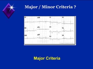 Major / Minor Criteria ?
Major Criteria
 