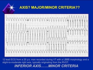 AXIS? MAJOR/MINOR CRITERIA??
12 lead ECG from a 25 y.o. man recorded during VT with a LBBB morphology and a
slight-to-moderate right axis, typically originating from the RVOT.
INFERIOR AXIS……MINOR CRITERIA
 