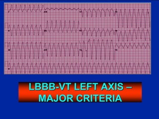 LBBB-VT LEFT AXIS –
MAJOR CRITERIA
 