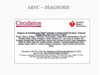 ARVC – DIAGNOSIS
“ARRYTHMOGENIC RIGHT
VENTRICULAR
CARDIOMYOPATHY”
 