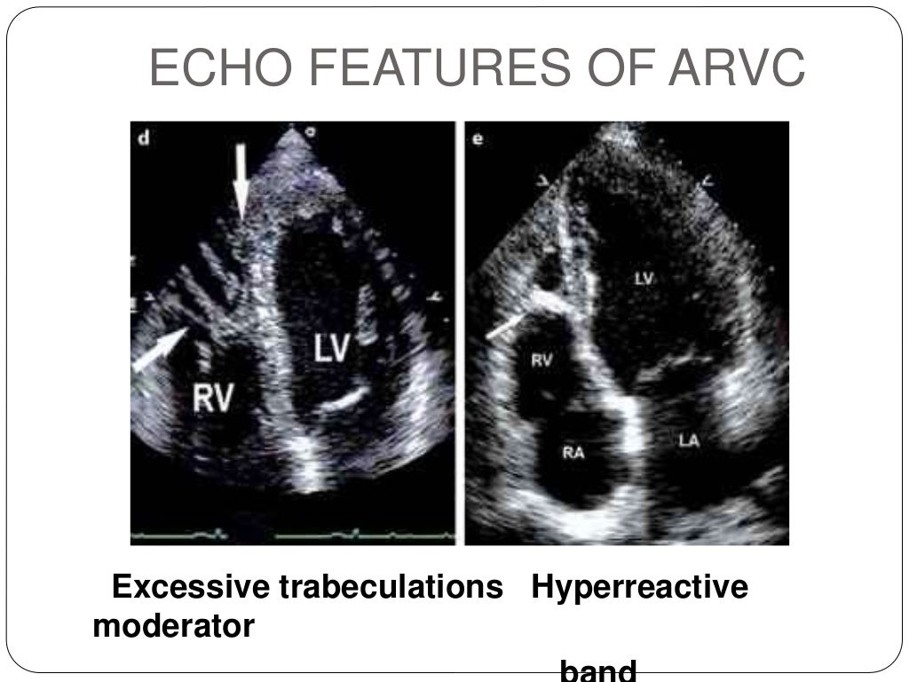 ARVD (Arrythmogenic right ventricular cardiomyopathy) updated task