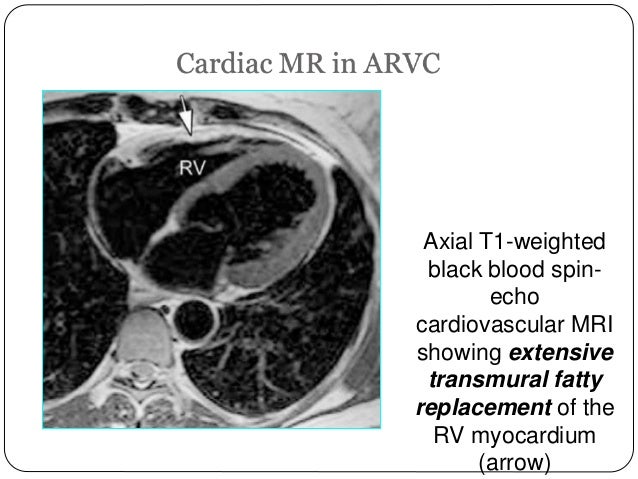 ARVD (Arrythmogenic ri...