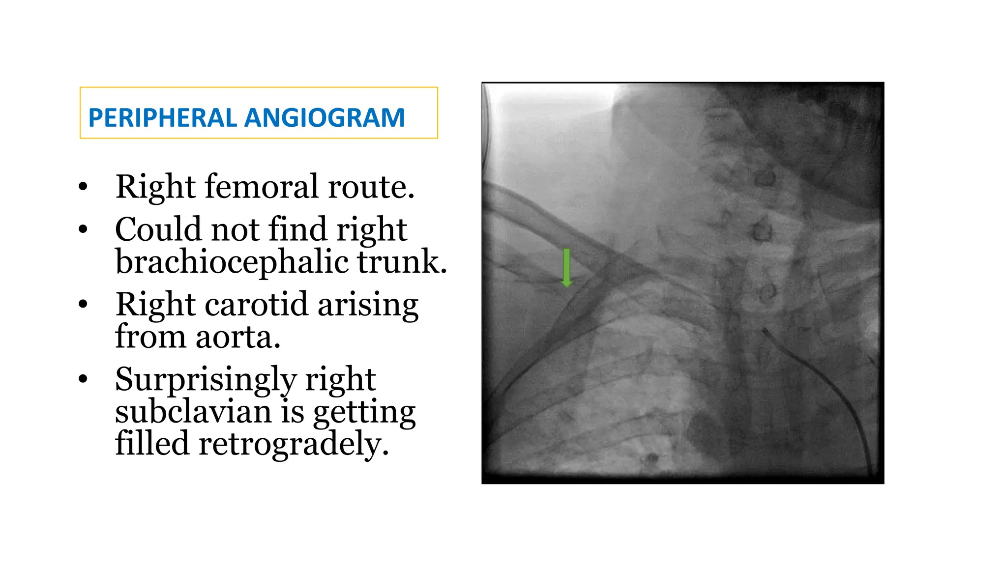 STENOSIS OF ABBERANT RIGHT SUBCLAVIAN ARTERY WITH KOMMERELL ...