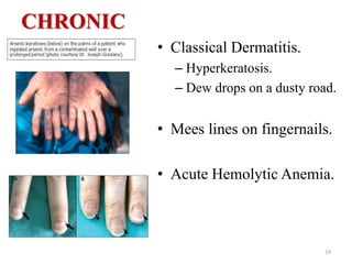 CHRONIC
• Classical Dermatitis.
– Hyperkeratosis.
– Dew drops on a dusty road.
• Mees lines on fingernails.
• Acute Hemolytic Anemia.
19
 
