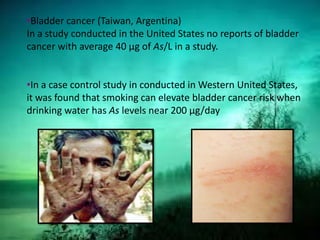 •Bladder cancer (Taiwan, Argentina)
In a study conducted in the United States no reports of bladder
cancer with average 40 µg of As/L in a study.
•In a case control study in conducted in Western United States,
it was found that smoking can elevate bladder cancer risk when
drinking water has As levels near 200 µg/day
 