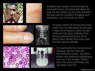 A patient was bought to the Emergency ward with history of rashes and blebs all over his skin mainly on his arms and feet. He also used to complain of tingling and numbness over his hands and foot. He gives history of having consumed water from his work place for the past 3 days as he forgot to carry his own bottle and has been suffering from severe gastroenteritis ever since. Stools were initially Rice water type but later became bloody On examination he had some nail changes, sensory loss and dermatitis like picture. His blood picture and abdomen radiography were as in the images. Patient went into shock and finally was admitted in the ICU 1 Telugu Doctors.co.in 