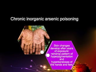 Chronic inorganic arsenic poisoning
Skin changes
develop after years
of exposure:
raindrop pattern of
hyperpigmentation
and
hyperkeratoses of
the hands and feet.
 
