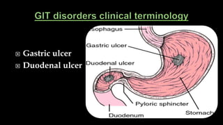  Gastric ulcer
 Duodenal ulcer
 