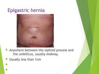 Epigastric hernia
 Anywhere between the xiphoid process and
the umbilicus, usually midway.
 Usually less than 1cm


 