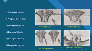 Intrapulpal LOCAL ANESTHESIA IN ORAL AND MAXILLOFACIAL SURGERY | PDF
