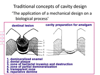 Traditional concepts of cavity design
Mechanical retention
– Flat floors
– Vertical walls
– Triangular retention
niches
– ...