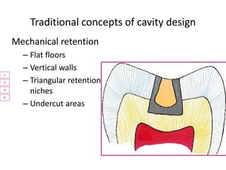 Biological principals of cavity preparation
1
2
 
