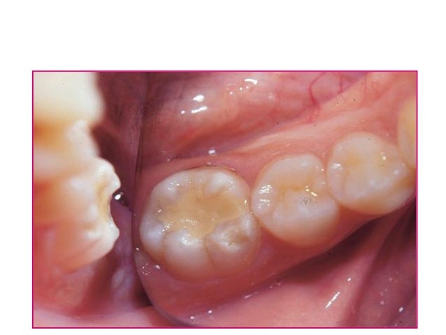 atraumatic restorative treatment for dental caries Art has become one of the most effective treatment, especially for children, in the management of tooth decay it emphasizes prevention and minimal invasiveness in dental treatment. atraumatic restorative treatment for dental caries Art has become one of the most effective treatment, especially for children, in the management of tooth decay it emphasizes prevention and minimal invasiveness in dental treatment.
