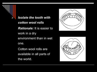  Isolate the tooth with
cotton wool rolls
Rationale: It is easier to
work in a dry
environment than in wet
one.
Cotton wool rolls are
available in all parts of
the world.
 