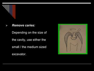  Remove caries:
Depending on the size of
the cavity, use either the
small / the medium sized
excavator.
 
