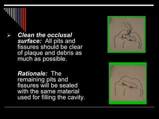  Clean the occlusal
surface: All pits and
fissures should be clear
of plaque and debris as
much as possible.
Rationale: The
remaining pits and
fissures will be sealed
with the same material
used for filling the cavity.
 