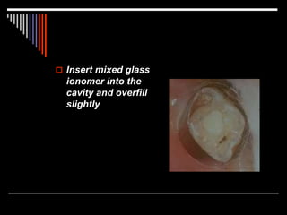  Insert mixed glass
ionomer into the
cavity and overfill
slightly
 