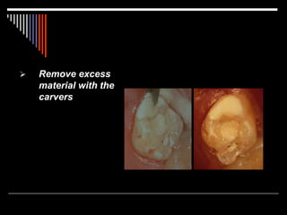  Remove excess
material with the
carvers
 