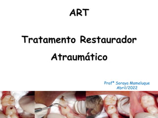 Profª Soraya Mameluque
Abril/2022
ART
Tratamento Restaurador
Atraumático
 