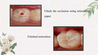 Finished restoration
Check the occlusion using articulating
paper
 