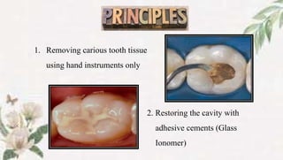 PRINCIPLES
1. Removing carious tooth tissue
using hand instruments only
2. Restoring the cavity with
adhesive cements (Glass
Ionomer)
 