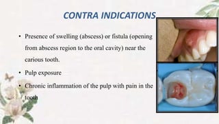 CONTRA INDICATIONS
• Presence of swelling (abscess) or fistula (opening
from abscess region to the oral cavity) near the
carious tooth.
• Pulp exposure
• Chronic inflammation of the pulp with pain in the
tooth
 