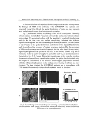 5 Identification of the urinary stone composition upon extracorporeal shock wave lithotripsy 111
In order to elucidate this aspect of mixed composition of some urinary stones,
the findings of FTIR were correlated with SEM-EDAX and detailed data
generated. Using SEM-EDAX, the spatial distribution of major and trace elements
were studied to understand their initiation and formation.
Fig. 3 presents the surface morphology of the mixed kidney stone containing
calcium oxalate monohydrate / calcium carbonate (a) and cystine/calcium oxalate
monohydrate (b) respectively, along with the quantitative results of the elemental
analysis. In the first case, the surface morphology indicates two different
crystallization regions, the dark colored region showing a reduced calcium content
as was revealed by the spatial distribution (not shown in this figure).The elemental
analysis confirmed the presence of oxalate structures, indicated by the percentage
of different elements present in a single sample. On the other hand, the uncertainty
regarding the presence of cystine or uric acid in the second sample (Fig. 3b) is
eliminated by the evidence of sulphur in elemental analysis, as cystine structure is
characterized by –S–S– bonds. The surface morphology in this case also confirms
the existence of two different crystallization regions, the spatial distribution indicating
that sulphur is concentrated in the massive, parallelepiped grey-colored structure,
while the white colored deposits on the surface consist mainly of calcium and trace
elements. The data obtained by SEM-EDAX analysis are in concordance with
FTIR spectral features and with previously reported results in literature.
Fig. 3. The morphology of the mixed kidney stone containing: a. calcium oxalate monohydrate /
calcium carbonate, and b. cystine / calcium oxalate monohydrate respectively, and the corresponding
EDS spectra of the compound elements.
 