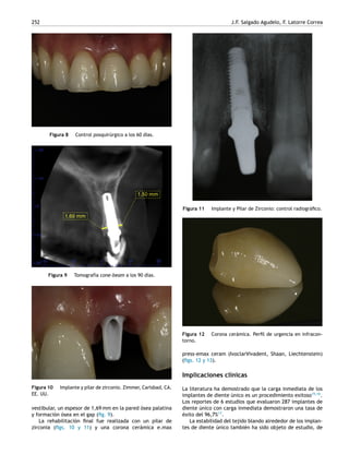 252 J.F. Salgado Agudelo, F. Latorre Correa
Figura 8 Control posquirúrgico a los 60 días.
Figura 9 Tomografía cone-beam a los 90 días.
Figura 10 Implante y pilar de zirconio. Zimmer, Carlsbad, CA.
EE. UU.
vestibular, un espesor de 1,69 mm en la pared ósea palatina
y formación ósea en el gap (ﬁg. 9).
La rehabilitación ﬁnal fue realizada con un pilar de
zirconia (ﬁgs. 10 y 11) y una corona cerámica e.max
Figura 11 Implante y Pilar de Zirconio: control radiográﬁco.
Figura 12 Corona cerámica. Perﬁl de urgencia en infracon-
torno.
press-emax ceram (IvoclarVivadent, Shaan, Liechtenstein)
(ﬁgs. 12 y 13).
Implicaciones clínicas
La literatura ha demostrado que la carga inmediata de los
implantes de diente único es un procedimiento exitoso15,16
.
Los reportes de 6 estudios que evaluaron 287 implantes de
diente único con carga inmediata demostraron una tasa de
éxito del 96,7%17
.
La estabilidad del tejido blando alrededor de los implan-
tes de diente único también ha sido objeto de estudio, de
 