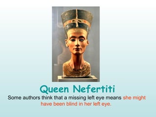 Queen Nefertiti
Some authors think that a missing left eye means she might
have been blind in her left eye.
 