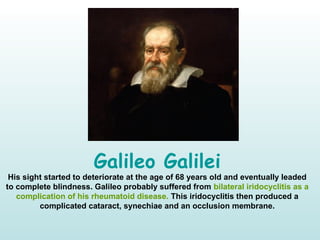 Galileo Galilei
His sight started to deteriorate at the age of 68 years old and eventually leaded
to complete blindness. Galileo probably suffered from bilateral iridocyclitis as a
complication of his rheumatoid disease. This iridocyclitis then produced a
complicated cataract, synechiae and an occlusion membrane.
 