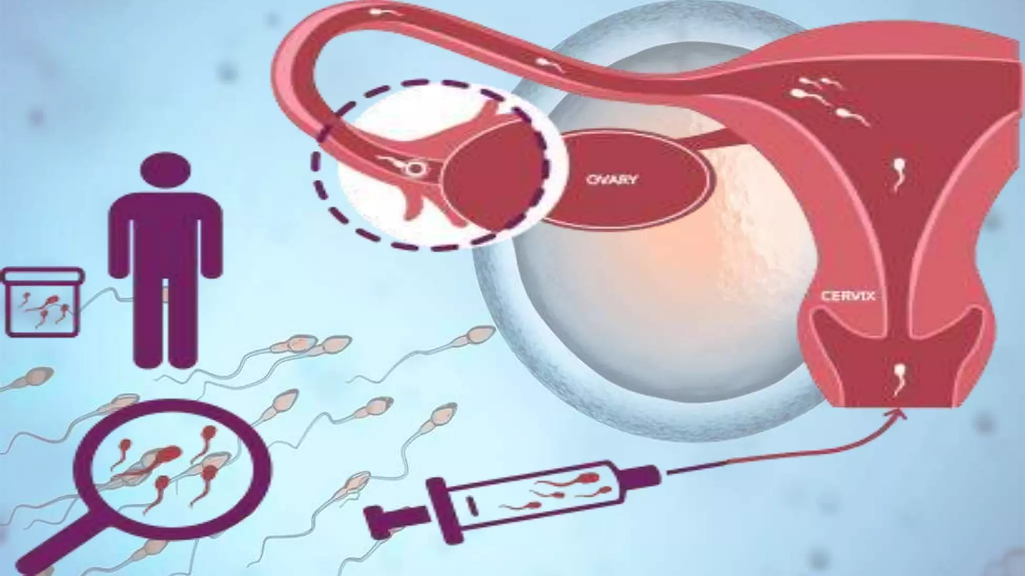 The Assisted Reproductive Techniques - ART (IVF, IUI, ZIFT, GIFT, ICSI ...