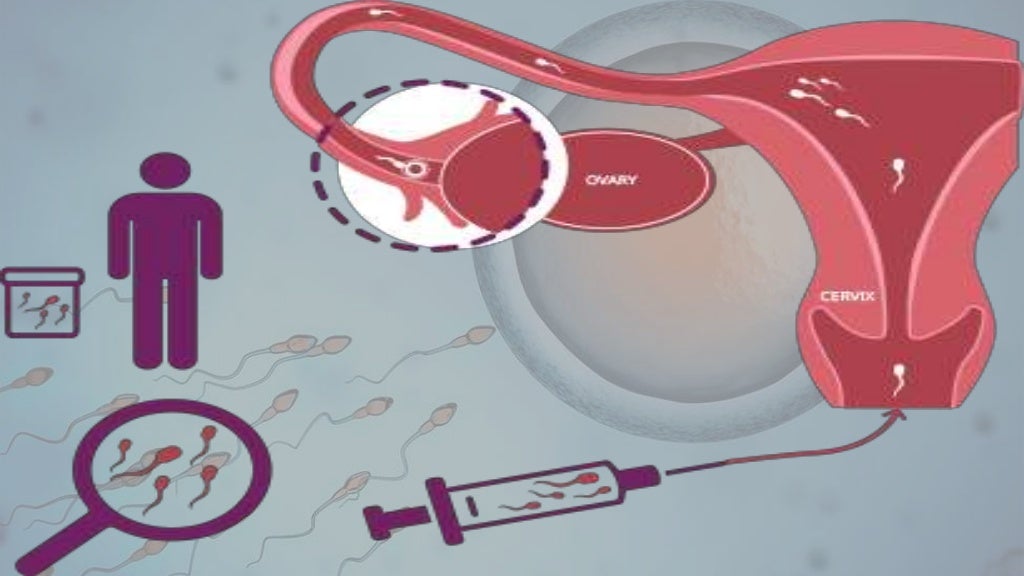 The Assisted Reproductive Techniques ART (IVF, IUI, ZIFT, GIFT, ICS…