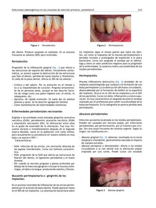 Infecciones odontogénicas en las consultas de atención primaria: ¿antibiótico? 613
Figura 1 Periodontitis.
del diente. Produce sangrado al cepillado. Es un proceso
frecuente en adultos (50%) pero reversible.
Periodontitis
Progresión de la inflamación gingival (fig. 1) que afecta a
las estructuras de soporte del diente. Inicialmente asinto-
mática, su avance supone la destrucción de las estructuras
que fijan el diente, pérdida de hueso maxilar y, finalmente,
la caída de la pieza dental. Afecta al 30% de los adultos2
.
- Crónica o del adulto. Por su evolución en el tiempo y
no a su imposibilidad de curación. Progresa lentamente.
Se da en personas sanas, aunque se han descrito facto-
res de riesgo como una pobre higiene oral, el estrés, el
tabaquismo, etc.
- Agresiva, de rápida evolución. Se suele dar en adultos
jóvenes y sanos. Se ha descrito agregación familiar
- Como manifestación de enfermedades sistémicas.
Enfermedades periodontales necrosantes
Engloba a las entidades antes llamadas gingivitis ulcerativa
necrótica (GUN), periodontitis ulcerativa necrótica (PUN)
y estomatitis necrosante (EN). Se diferencian entre ellas
en el grado de severidad de la afectación. Fue muy fre-
cuente durante e inmediatamente después de la Segunda
Guerra Mundial, tanto en la población civil como militar,
pero actualmente su prevalencia en nuestro ámbito es muy
baja y se asocia a VIH+3
.
Características:
- GUN: infección de las encías, con ulceración dolorosa de
las papilas interdentales. Cursa con halitosis caracterís-
tica.
- PUN: progresión de la GUN que afecta las estructuras de
fijación del diente, el ligamento periodontal y el hueso
alveolar.
- EN: cuando la necrosis progresa a planos profundos por
debajo de la línea mucogingival e incluye la mucosa orofa-
ríngea, el labio o la lengua, produciendo osteítis y fístulas.
Mucositis periimplantaria o «gingivitis de los
implantes»
Es un proceso reversible de inflamación de las encías periim-
plante por el acúmulo de placa dental. Puede aparecer hasta
en el 50% de los implantes. La colonización bacteriana sobre
Figura 2 Periimplantitis.
los implantes sigue el mismo patrón que sobre los dien-
tes, así como la respuesta de la mucosa periimplantaria a
periodos iniciales y prolongados de exposición a la placa
bacteriana. Cursa con sangrado al sondaje por el odontó-
logo y tiene un valor predictivo negativo para la progresión
de la enfermedad. Su ausencia indica una estabilidad de los
tejidos periodontales.
Periimplantitis
Proceso inflamatorio destructivo (fig. 2) alrededor de un
implante osteointegrado que conduce a la formación de una
bolsa periimplante y a la destrucción del hueso circundante,
desencadenado por la formación de biofilm en la superficie
del implante. Ocurre en el 16% de los implantes y en el 26%
de los pacientes. Cursa con dolor, inflamación y a veces supu-
ración. Es muy característico el sangrado durante el sondaje
realizado por el profesional para medir la profundidad de la
bolsa periimplante. En la radiografía se aprecia pérdida ósea
periimplante.
Abscesos periodontales
Infección purulenta localizada en los tejidos periodontales.
Pueden ser causados por necrosis pulpar, por infecciones
periodontales, por pericoronaritis, por un trauma o por ciru-
gía. Son una causa frecuente de consulta urgente. Según su
origen, los clasificamos en2
:
- Absceso gingival (fig. 3): doloroso, localizado en la encía
marginal e interdental, generalmente asociado al impacto
de cuerpos extraños.
- Absceso periapical o dentoaveolar: afecta a los tejidos
circundantes a la raíz dental tras la afectación pulpar
originada por una caries. Puede cursar con exudado
Figura 3 Absceso gingival.
 